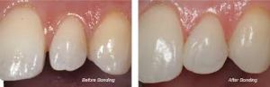 Dental Bonding