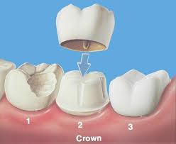 Dental Crown Image