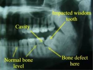 Extractions & Oral Surgery