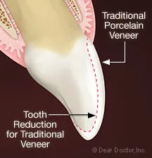 Porcelain Veneers graphics