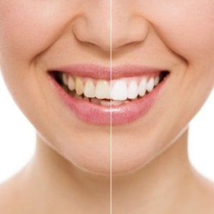 Woman Smiling with new set of Porcelain Veneers