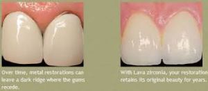Ceramic Crowns