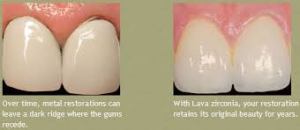 Ceramic Crowns